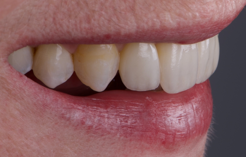 Obr. 20: Finální keramické rekonstrukce byly intraorálně zkontrolovány s ohledem na přesnost okrajového uzávěru, tvaru a estetiky. Adhezivní fixace byla provedena pomocí Variolink Esthetic DC.