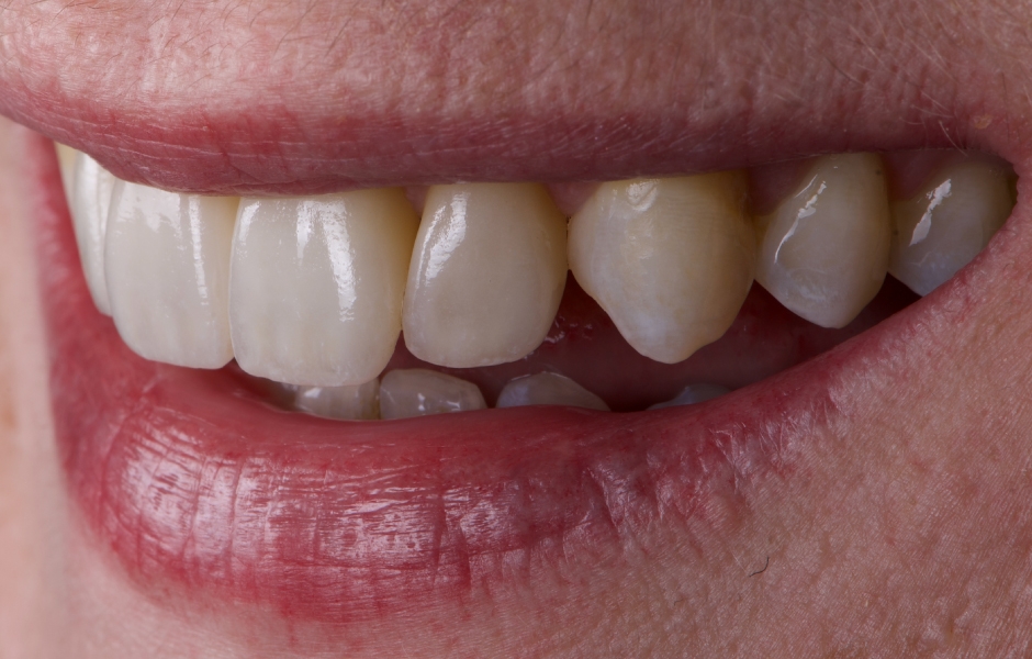 Obr. 21: Finální keramické rekonstrukce byly intraorálně zkontrolovány s ohledem na přesnost okrajového uzávěru, tvaru a estetiky. Adhezivní fixace byla provedena pomocí Variolink Esthetic DC.