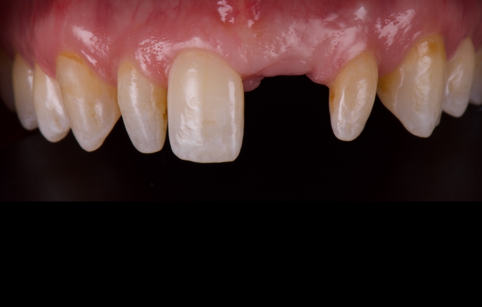 Obr. 3: I po provedení extrakční terapie zůstávala lokalita neuspokojivá pro zavedení implantátu.