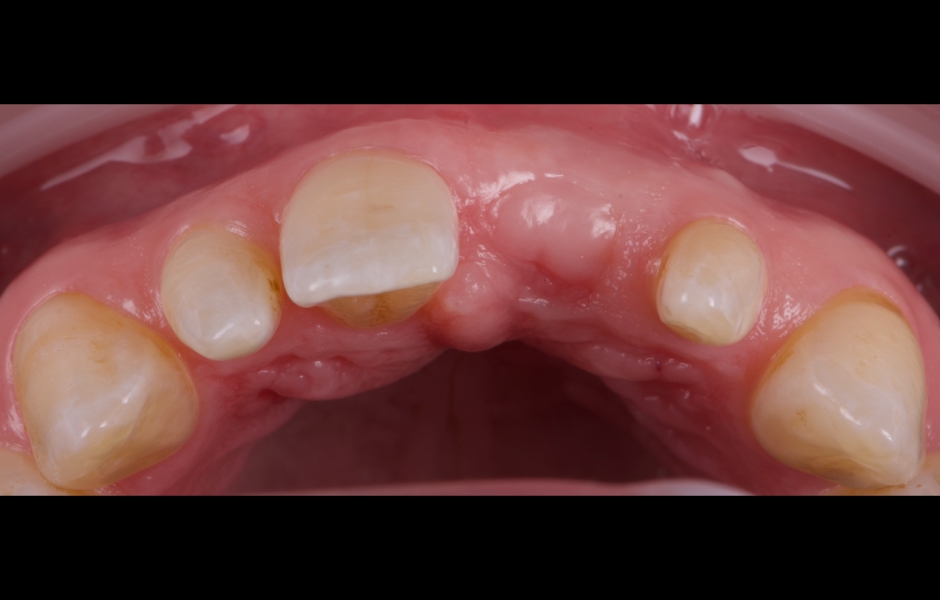 Obr. 4: I po provedení extrakční terapie zůstávala lokalita neuspokojivá pro zavedení implantátu.