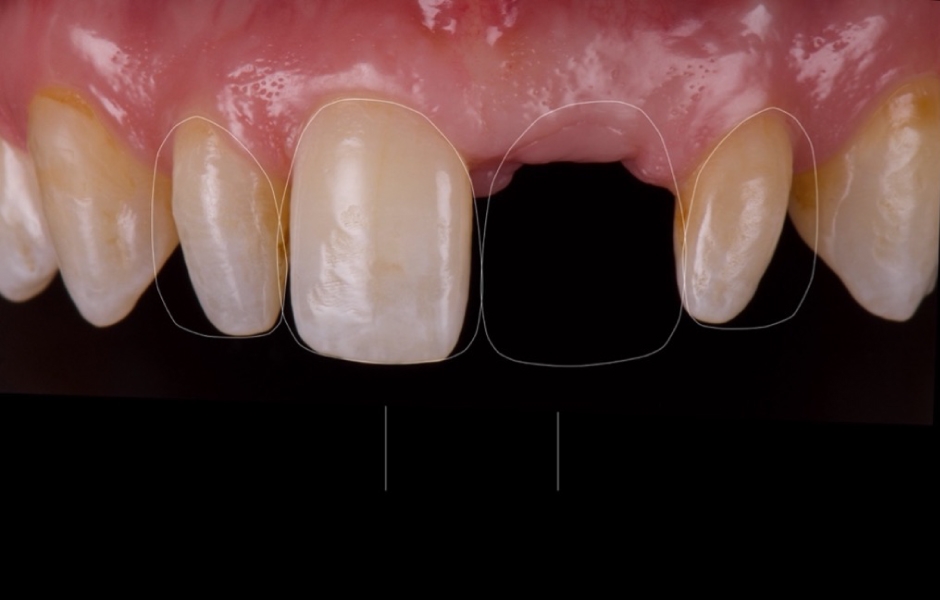 Obr. 5: Digital Smile Design (DSD) a 2D mock-up usnadnily vizualizaci navrhovaných změn.