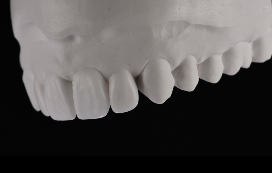 Obr. 7: Wax-up ukazuje potřebu meziálního rozšíření zubu 23.