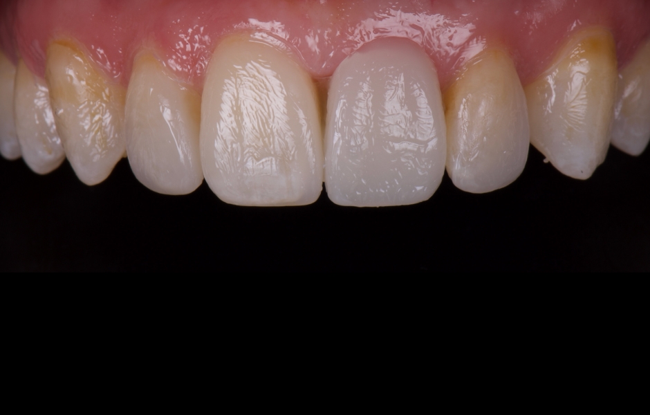 Obr. 8: Mock-up použitý k ověření tvaru a rozměrů zubů a k získání souhlasu pacientky.