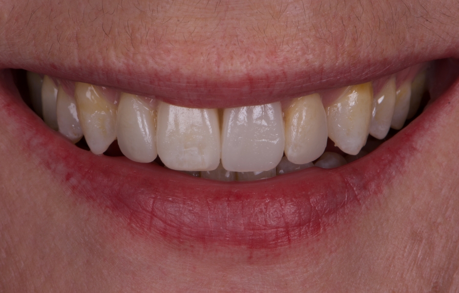 Obr. 9: Mock-up použitý k ověření tvaru a rozměrů zubů a k získání souhlasu pacientky.