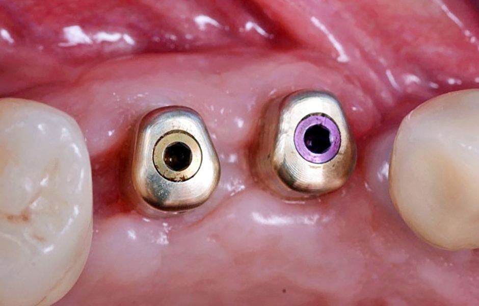 Obr. 1: Abutmenty iPhysio v pozici zubů 14 a 15.