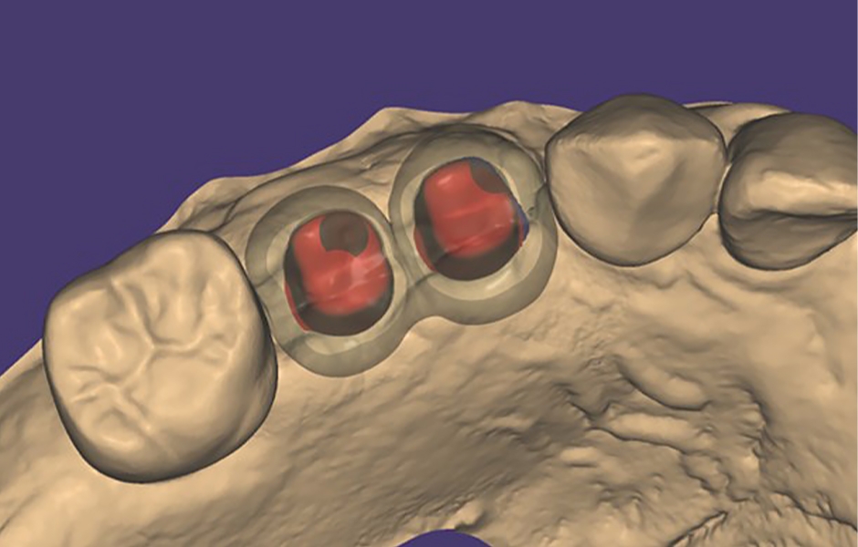 Obr. 10. Všimněte si podpory, kterou poskytují individuální abutmenty korunkovým náhradám.