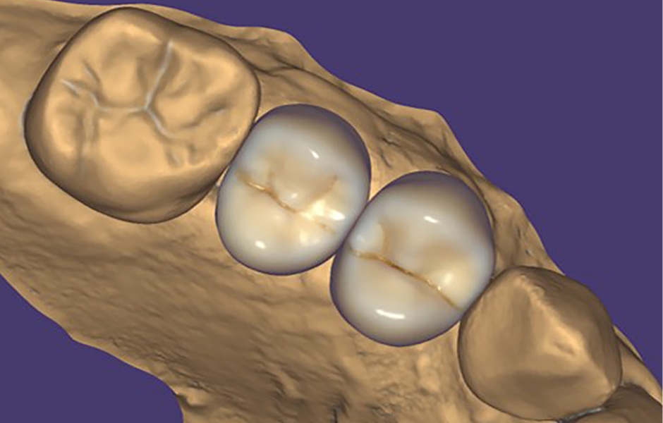 Obr. 11: Fotorealistická vizualizace náhrady pomocí Truesmile od Exocad.