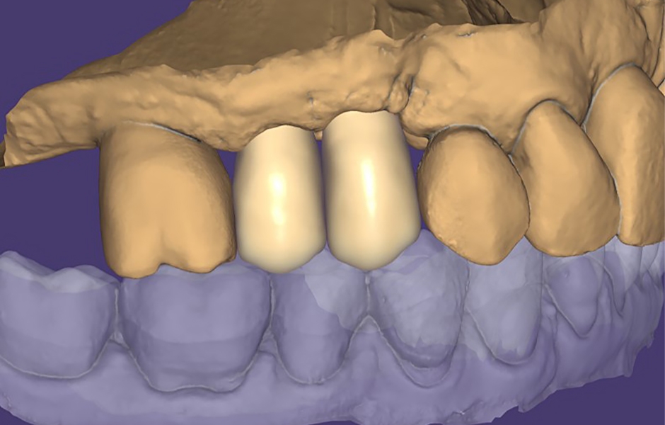 Obr. 12: Fotorealistická vizualizace náhrady pomocí Truesmile od Exocad.