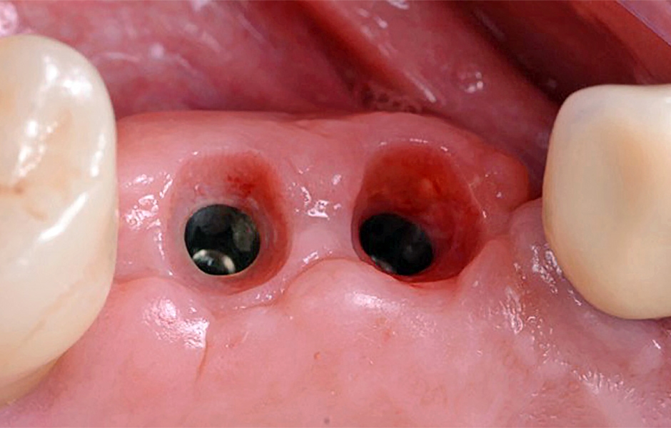 Obr. 17. Vynikající stav tkání po odstranění vhojovacích abutmentů iPhysio.