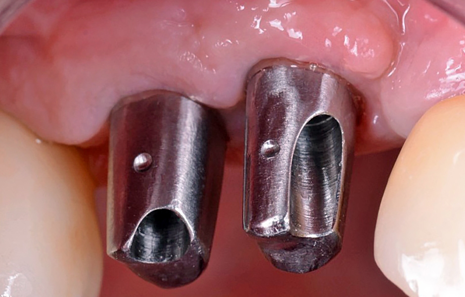 Obr. 18: Zavedení individuálních abutmentů vyfrézovaných společností LYRA ETK.