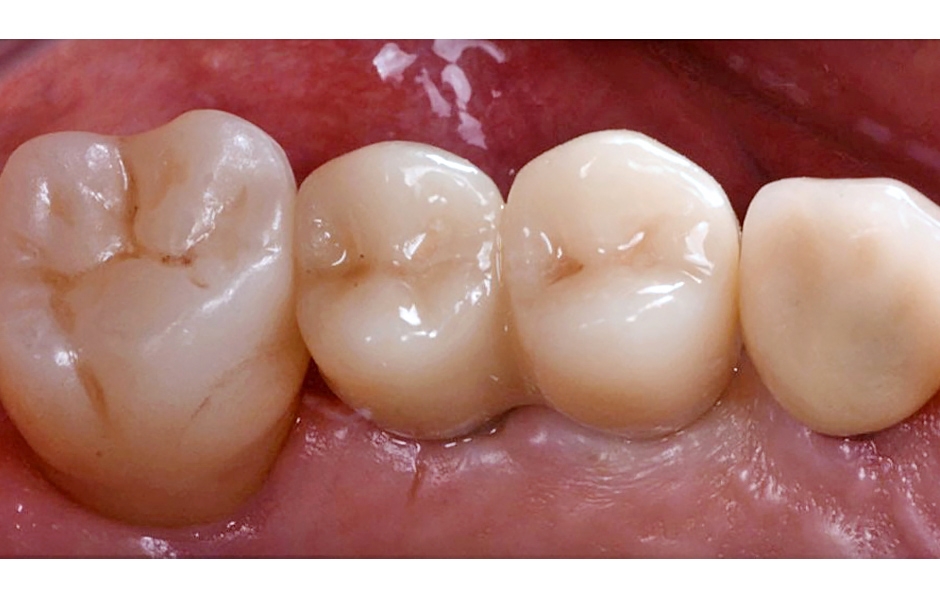Obr. 19: Definitivní náhrada vytištěná technologií TSLA na 3D tiskárně DFAB z hybridního kompozitu IRIX MAX (DWS Systems), cementovaná na individuální abutmenty.