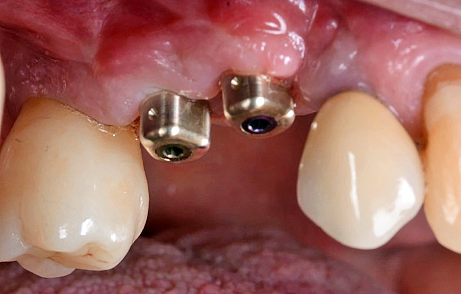 Obr. 2: Abutmenty iPhysio v pozici zubů 14 a 15.