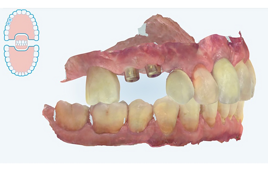 Obr. 3: Intraorální skeny pomocí iTero Element 5D Plus.