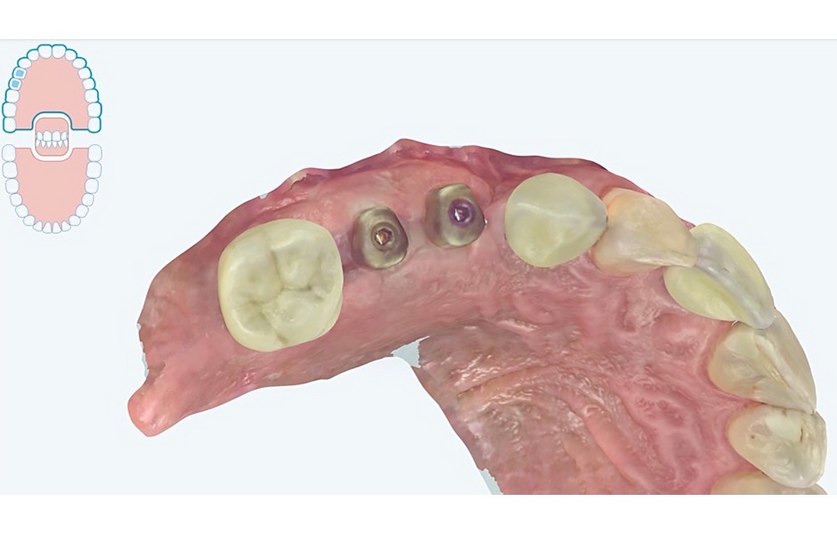 Obr. 4: Intraorální skeny pomocí iTero Element 5D Plus.