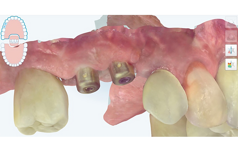 Obr. 5: Detail abutmentů iPhysio v intraorálním skenu.