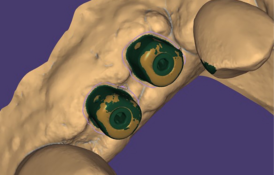 Obr. 6: Abutmenty iPhysio v CAD softwaru.