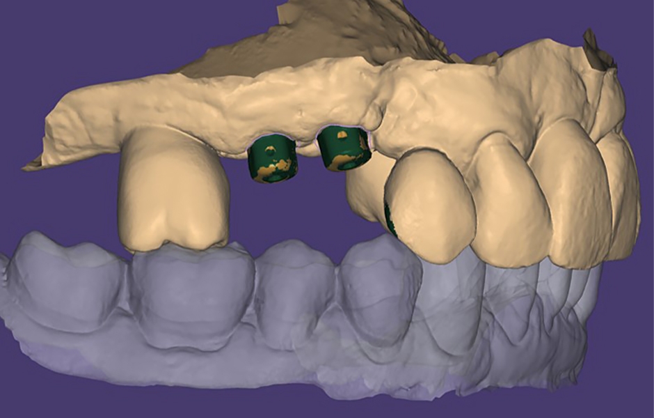 Obr. 7: Abutmenty iPhysio v CAD softwaru.