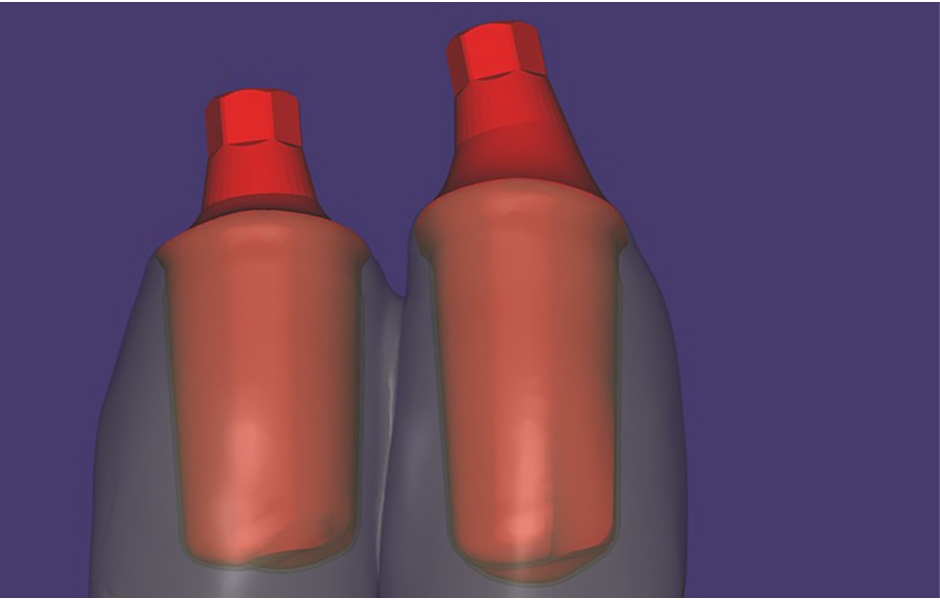 Obr. 8. Detail CAD modelace individuálních abutmentů a korunek.