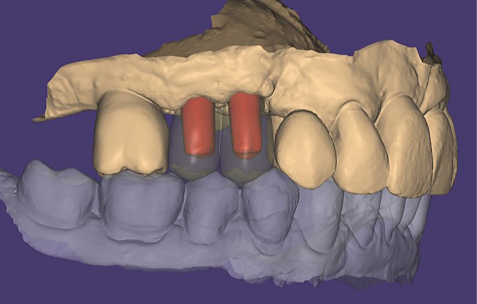 Obr. 9: CAD návrh korunek umístěný v kontextu virtuálních úst pacienta.