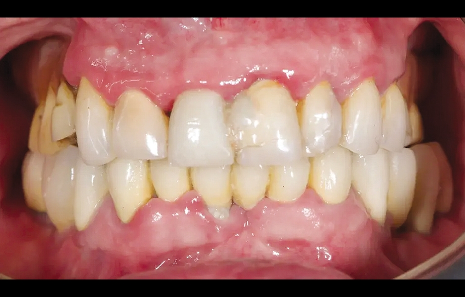 Obr. 1: Výchozí situace, čelní pohled. (Všechny snímky: Dr. Marco Tallarico a kol.).