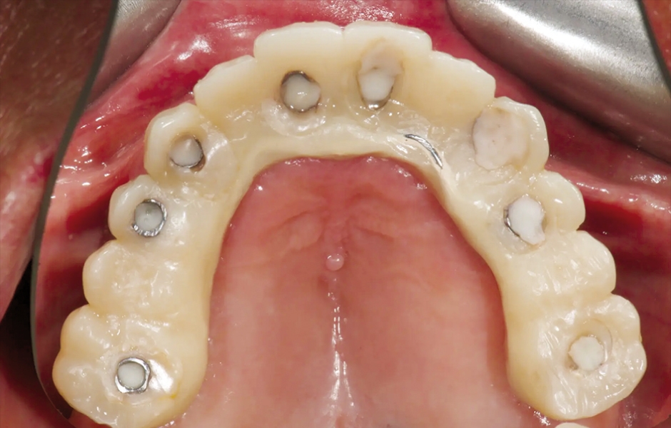 Obr. 12: Provizorní protetická práce s kovovou výztuhou in situ, okluzální pohled.