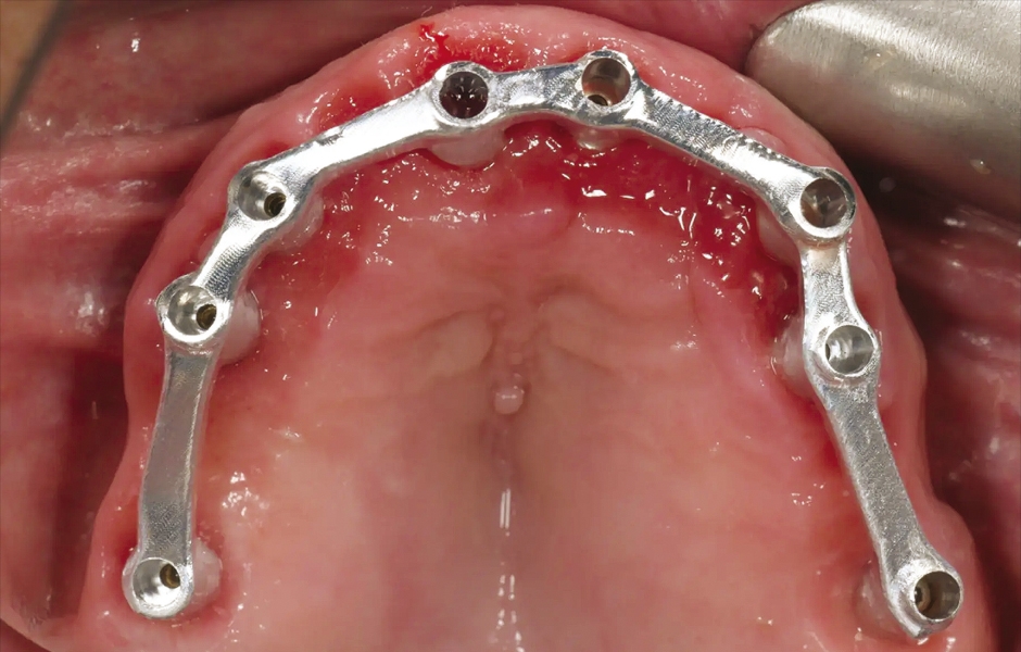 Obr. 15: Intraorální zkouška kovové výztuže pro ověření přesnosti a pasivního dosedu.