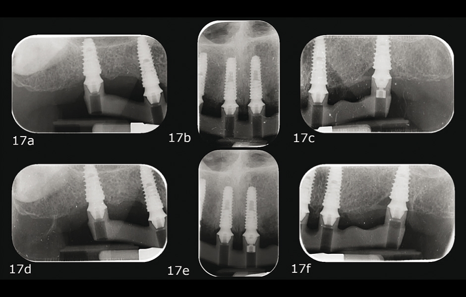 Obr. 17a–f: Kontrolní rentgenové snímky během one-screw testu.