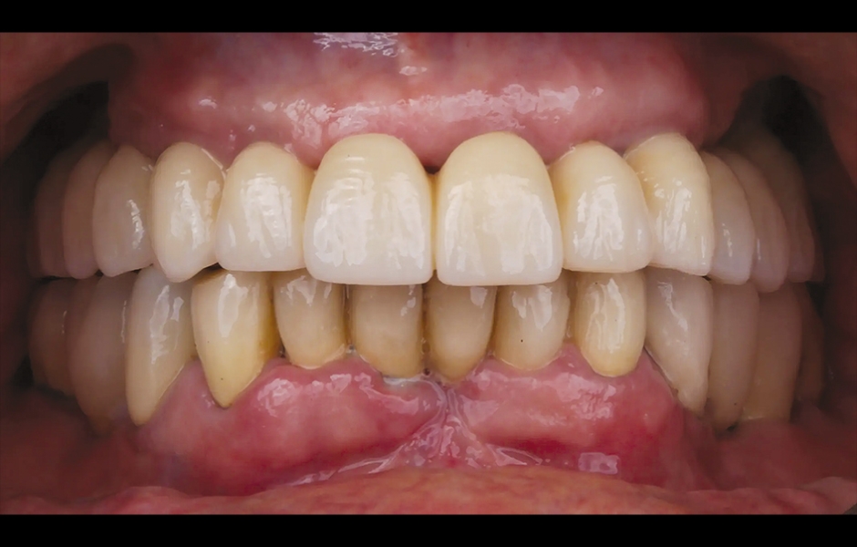 Obr. 19: Definitivní protetická práce při jednoroční kontrole, frontální pohled.