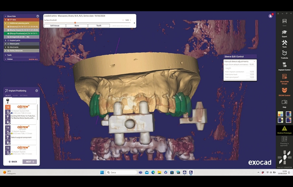 Obr. 3: Virtuální plánování implantátů. Sladění CBCT a intraorálních skenů pomocí externího značkovače v softwaru exoplan 3.1.