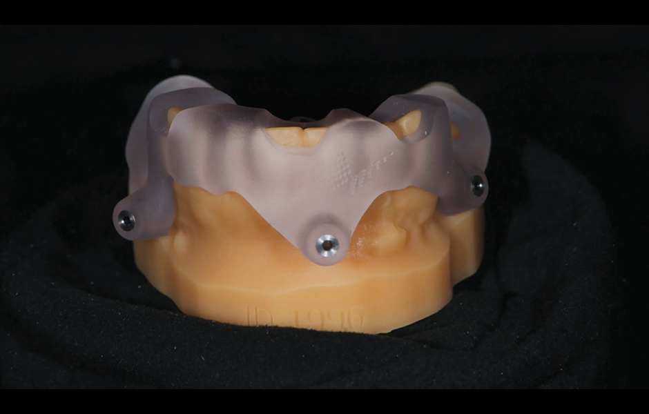 Obr. 6: Chirurgická šablona bez kovových pouzder pro přípravu fixačních pinů.