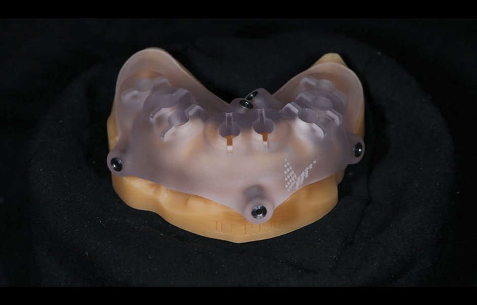 Obr. 7: Chirurgická šablona bez kovových pouzder pro plně navigovanou implantaci.