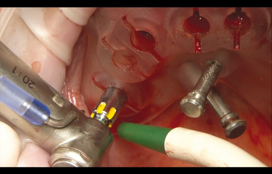 Obr. 8: Zavádění implantátu pomocí sady OneGuide KIT.