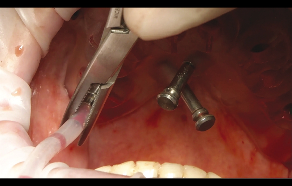 Obr. 9: Plně navigovaný krestální přístup do sinu pomocí sady OneCAS KIT.
