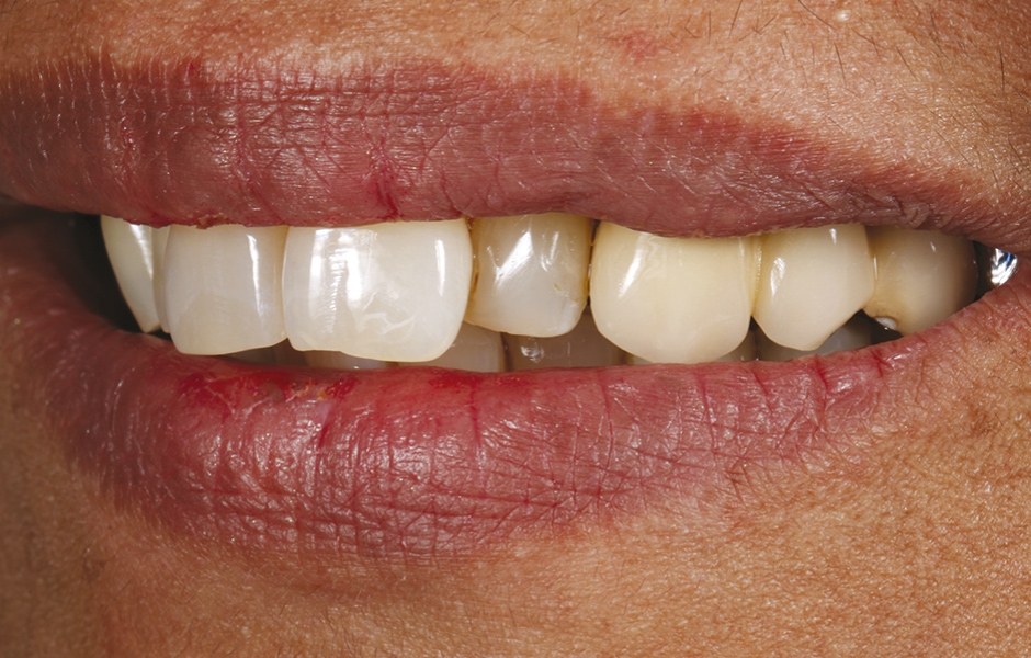 Obr. 1: Výchozí situace – levý horní postranní řezák je dislokován výrazně palatinálně vůči sousedním zubům. Tento stav pacientce z hlediska estetiky vadí a přeje si lepší vizuální začlenění zubu do zubního oblouku.