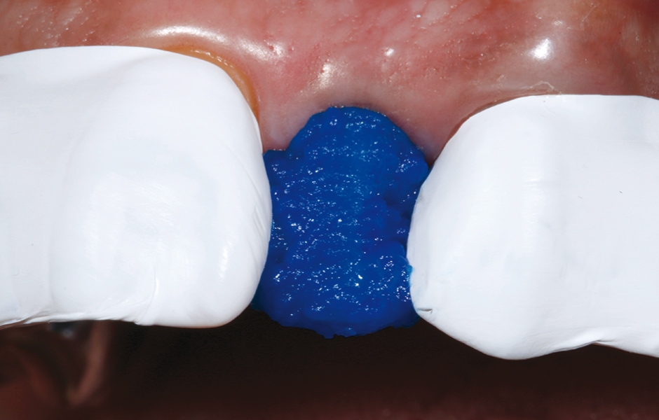 Obr. 10: Leptání skloviny a dentinu pomocí 35% kyseliny fosforečné.