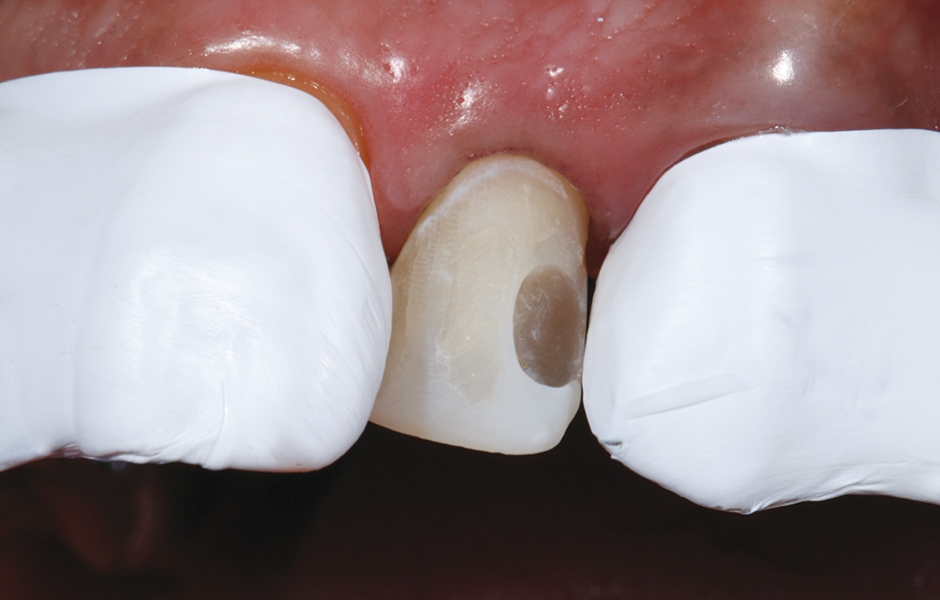 Obr. 11: Po důkladném oplachu kyseliny a rozpuštěných precipitátů byl zub vysušen proudem vzduchu.