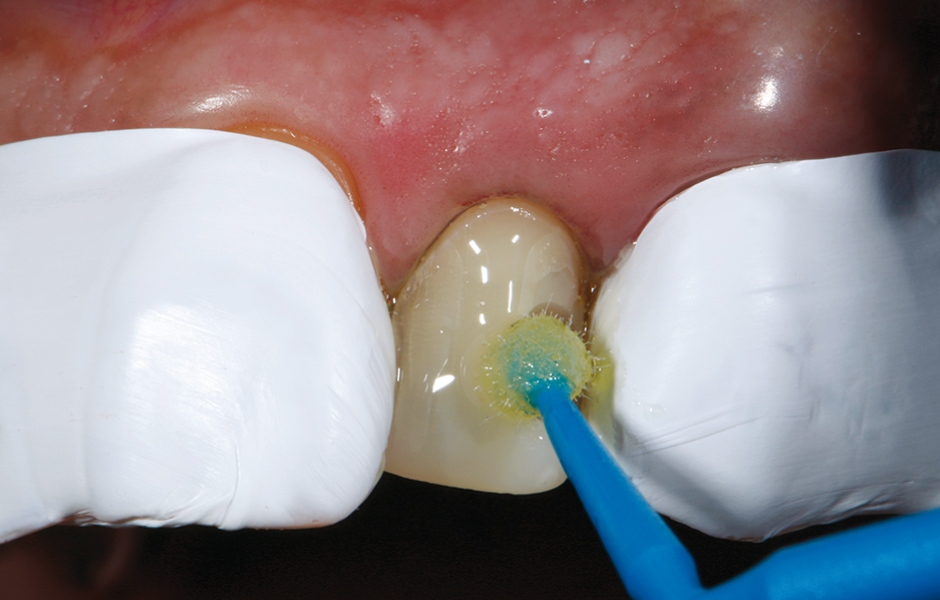 Obr. 12: Aplikace adheziva Futurabond M+ mikroštětečkem.
