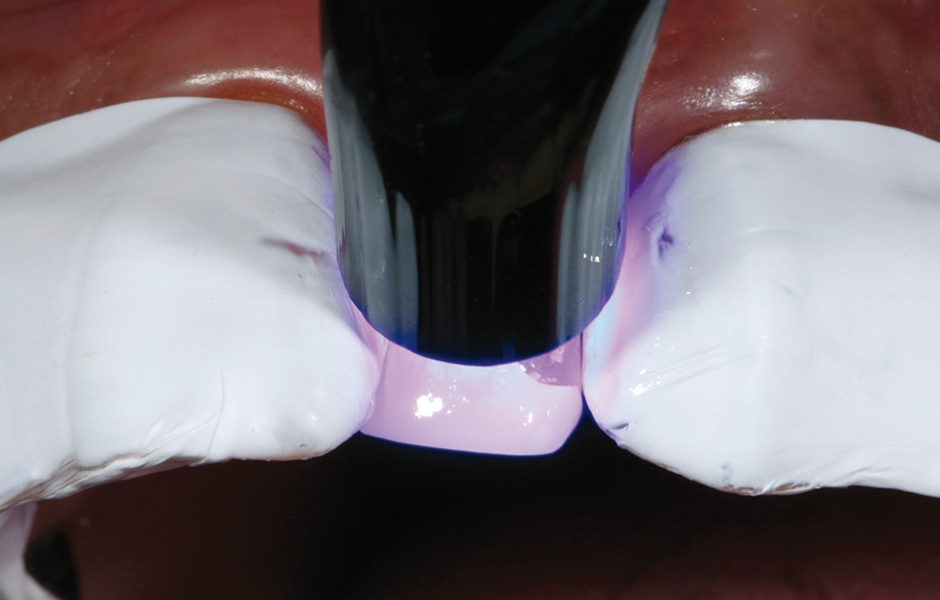 Obr. 14: Světelná polymerace adheziva po dobu 10 sekund.