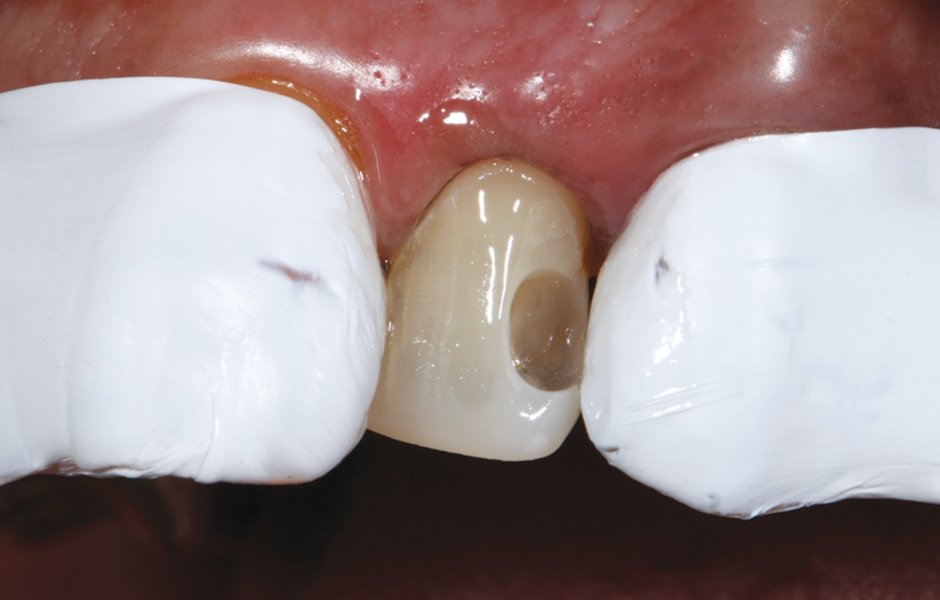 Obr. 15: Po aplikaci adheziva vykazuje preparace lesklý povrch.