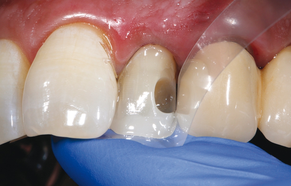 Obr. 16: Za pomoci matrice byla z volné ruky prodloužena klinická korunka a vymodelována incizální hrana postranního řezáku kompozitem GrandioSO® Unlimited.