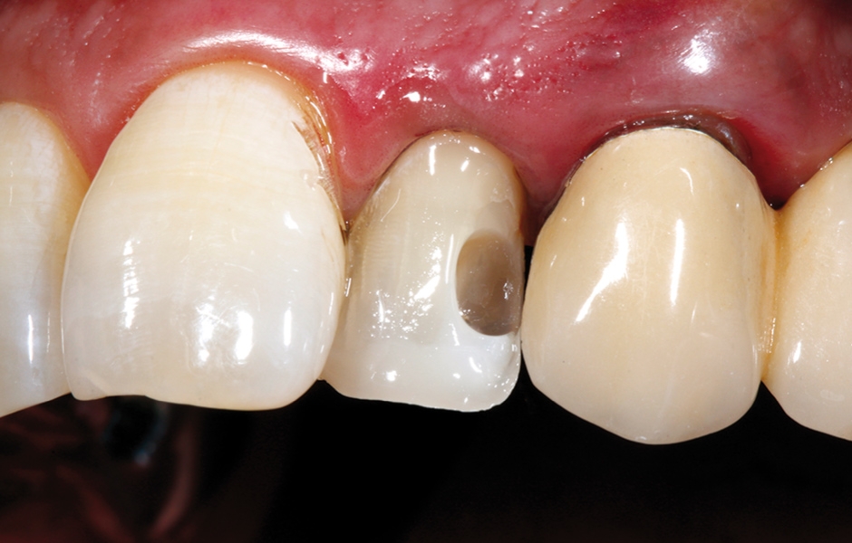 Obr. 17: Za pomoci matrice byla z volné ruky prodloužena klinická korunka a vymodelována incizální hrana postranního řezáku kompozitem GrandioSO® Unlimited.