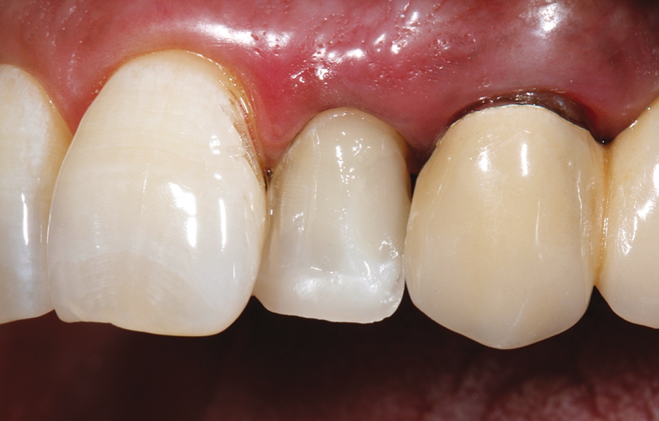 Obr. 18: Distální defekt zubu byl zaplněn kompozitem GrandioSO® Unlimited.