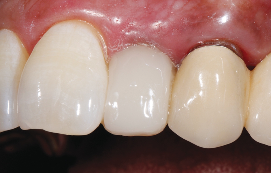 Obr. 19: Přímá fazeta z kompozitu GrandioSO® Unlimited zlepšila pozici postranního řezáku vzhledem k sousedním zubům.