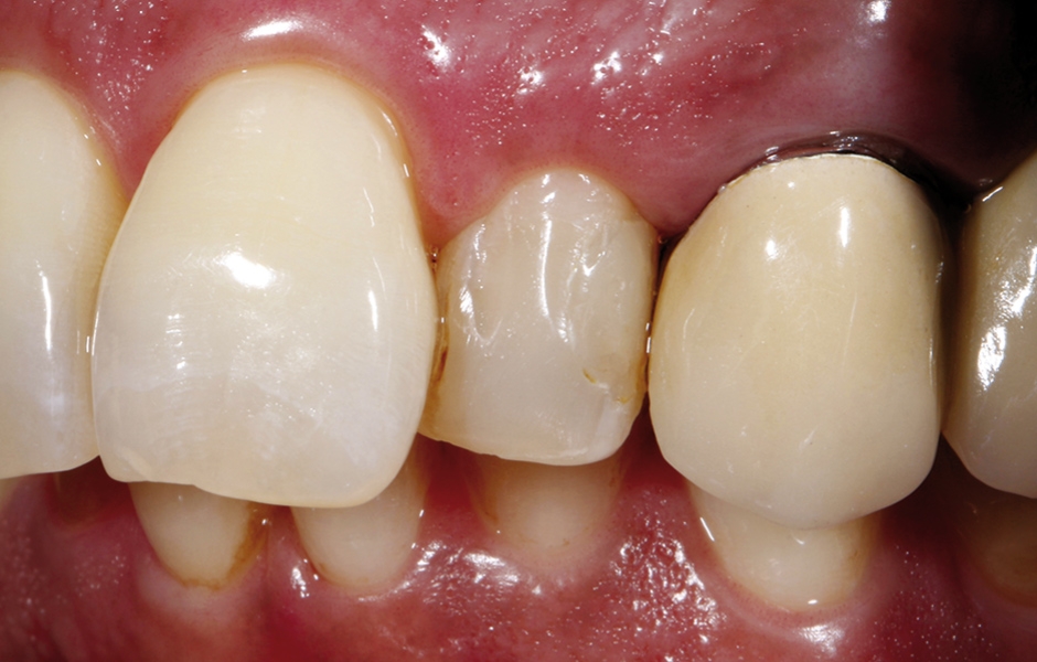 Obr. 2: Výchozí situace – levý horní postranní řezák je dislokován výrazně palatinálně vůči sousedním zubům. Tento stav pacientce z hlediska estetiky vadí a přeje si lepší vizuální začlenění zubu do zubního oblouku.