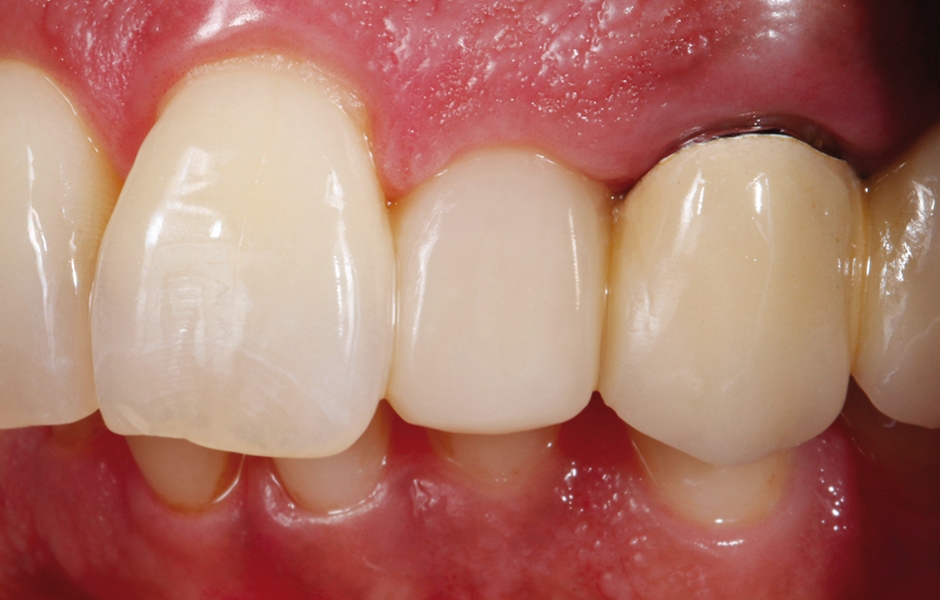 Obr. 20: Konečný stav – hotová přímá kompozitní fazeta s vysoce lesklým povrchem.