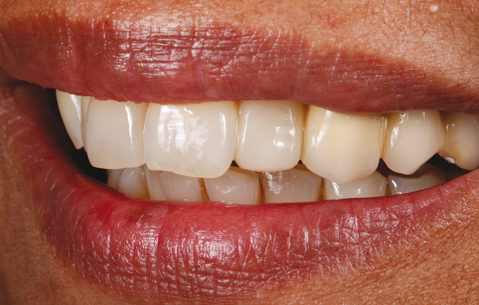 Obr. 21: Konečný stav – hotová přímá kompozitní fazeta s vysoce lesklým povrchem.