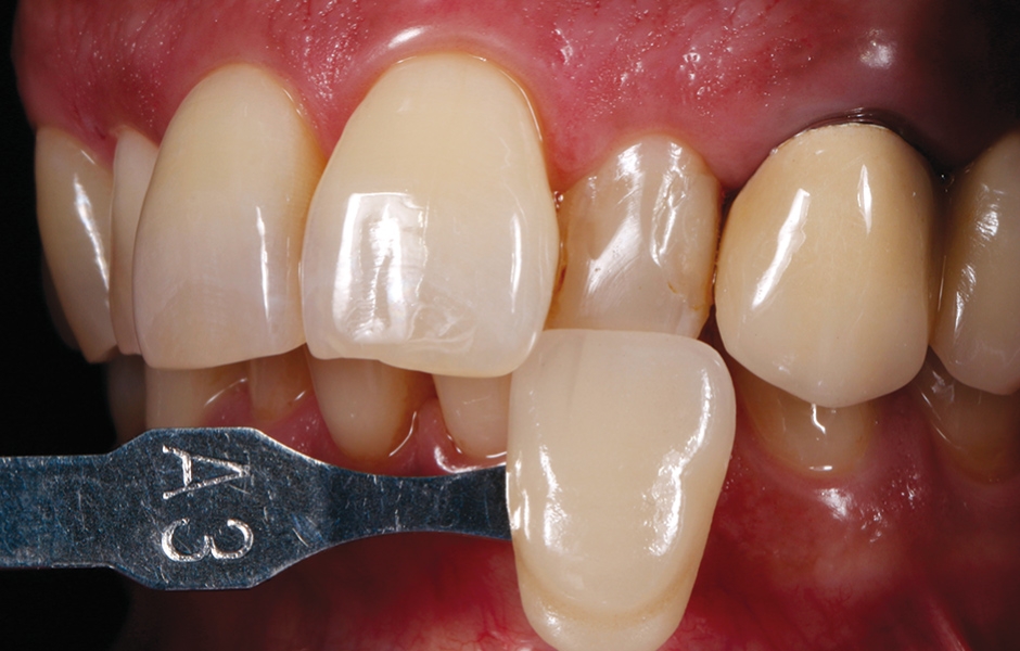 Obr. 3: Volba odstínu na vlhkém zubu.