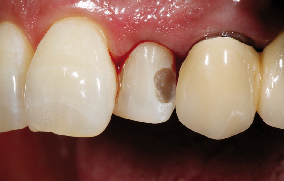 Obr. 5: Odtažení marginální gingivy retrakčním vláknem za účelem zpřístupnění krčkového okraje preparace – dochází ke krvácení ze sulku.