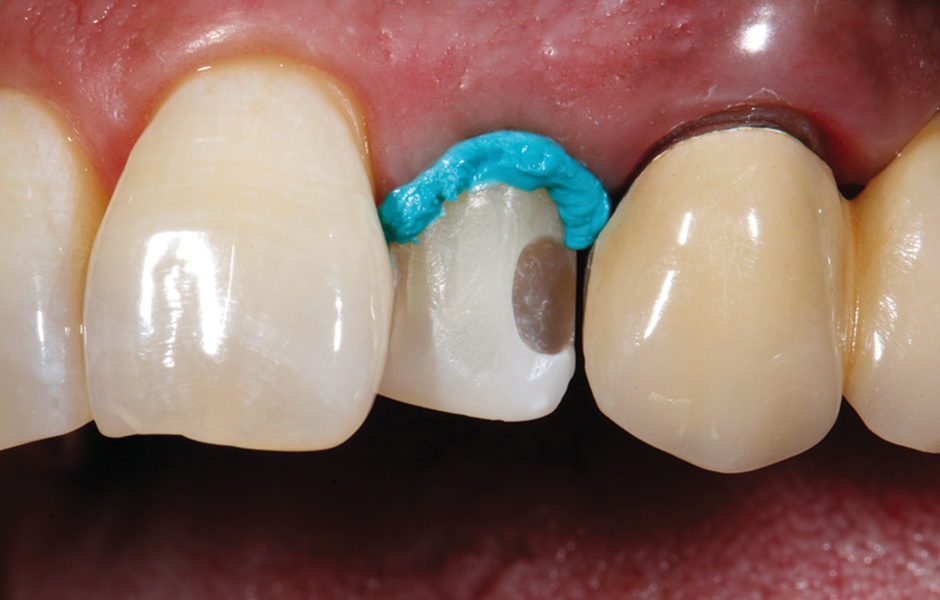 Obr. 6: Aplikace retrakční pasty s adstringentním účinkem (Retraction Paste, VOCO GmbH, Cuxhaven) do labiálního sulku.