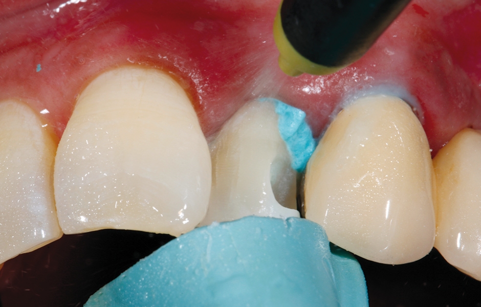 Obr. 7: Po dvouminutovém působení byla pasta opatrně odstraněna vodním sprejem za použití výkonného odsávání.